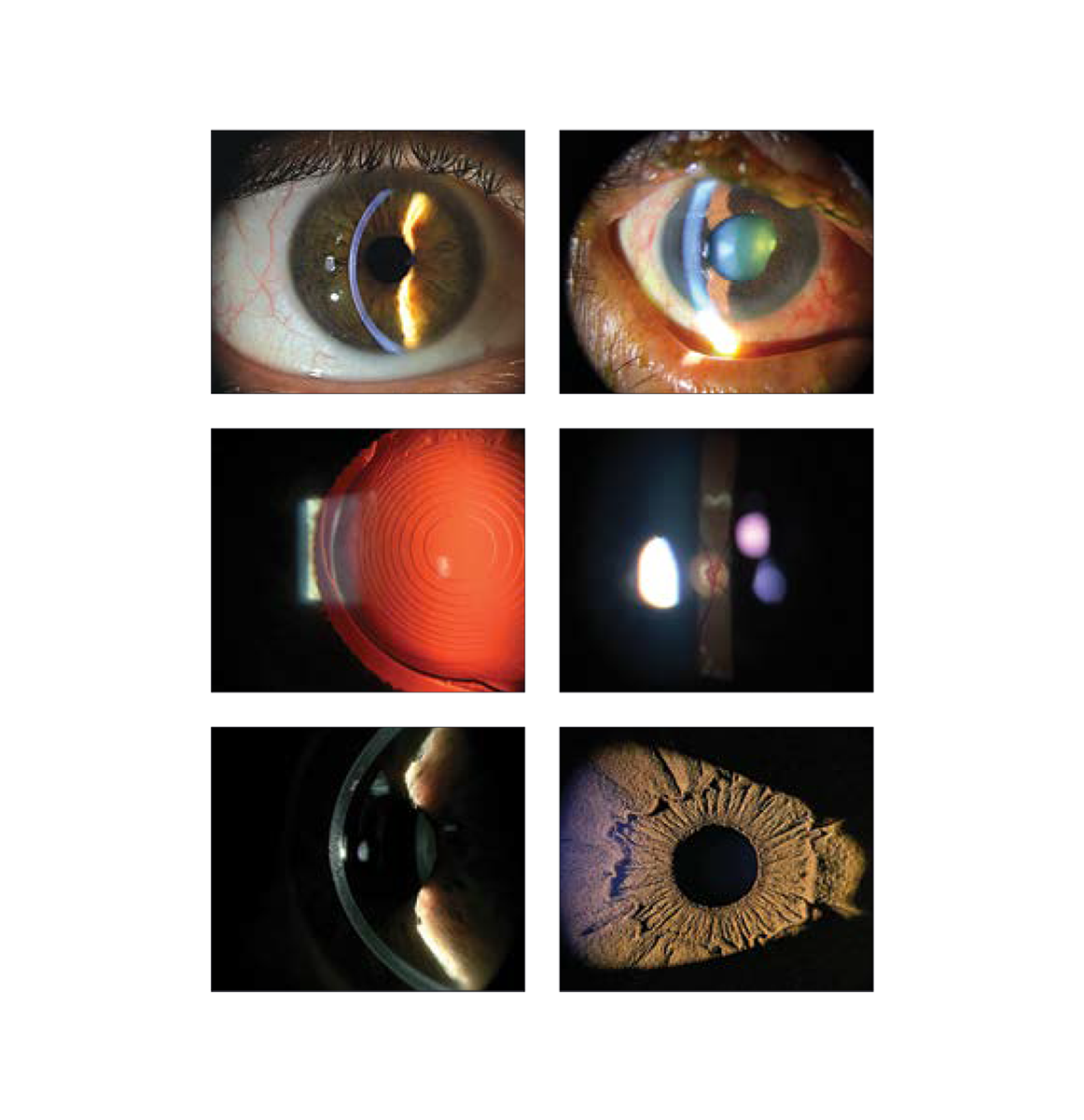 Ultra-Clear Anterior & Posterior Observations